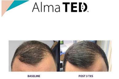 TED HAIR LOSS TREATMENT 