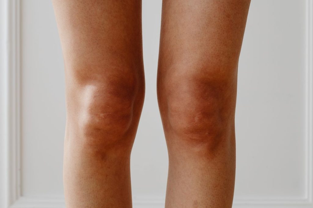 Can Regenerative Medicine Help Knee Osteoarthritis?