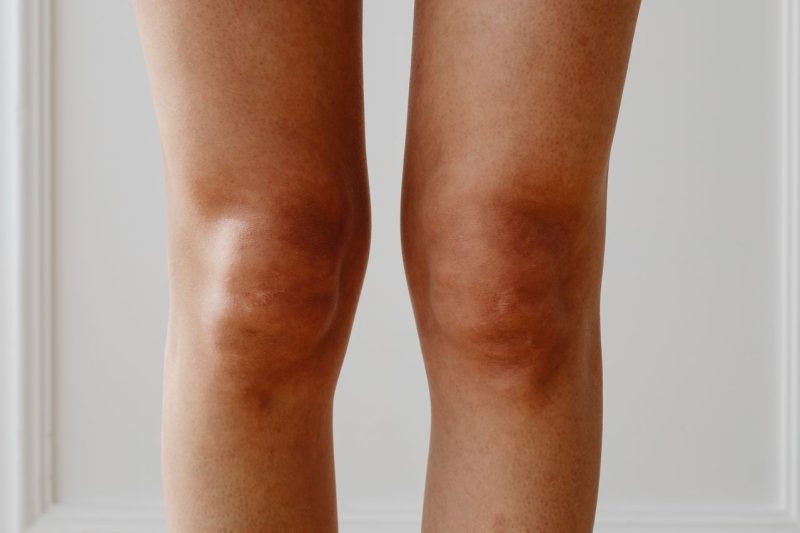 Can Regenerative Medicine Help Knee Osteoarthritis