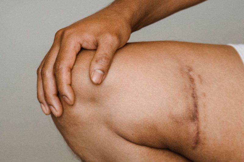 When Should I Consider Knee Replacement